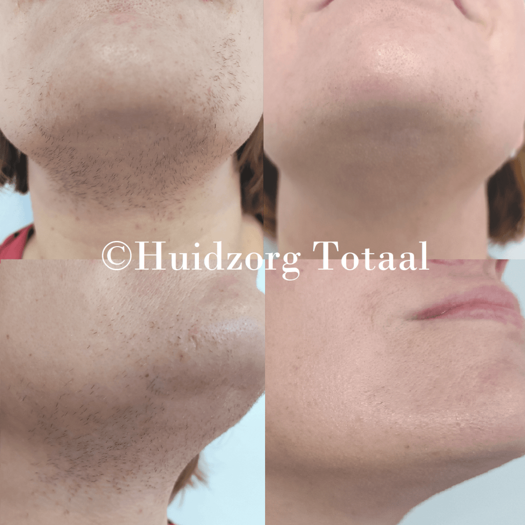 Laserontharing succesverhaal - Blij met resultaten