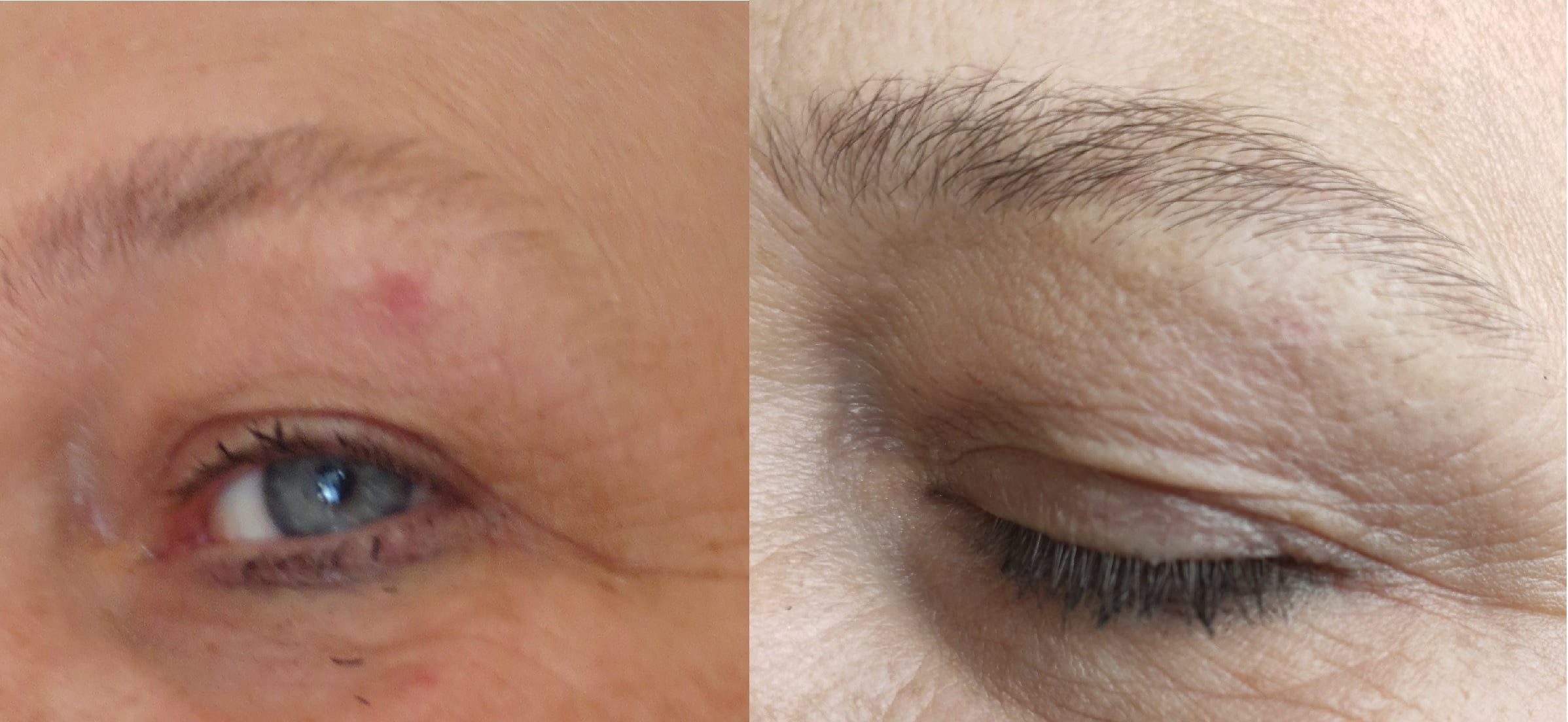 Spider naevi, spinnenkopje, coagulatie