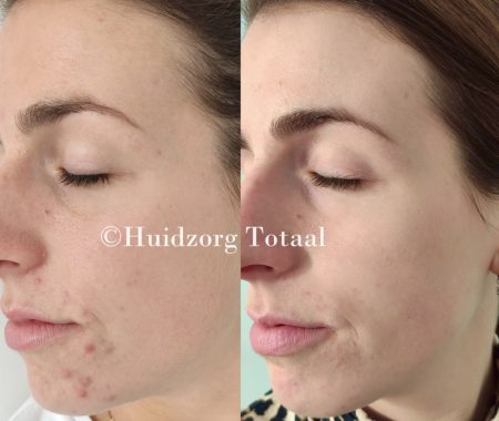 Acne behandeling, peeling,