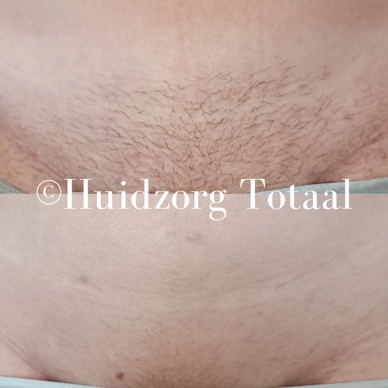 Voor en na resultaat van schaamstreek laserontharing in IJsselstein, professioneel en effectief